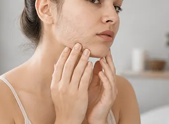 Hyperandrogenemia in Women