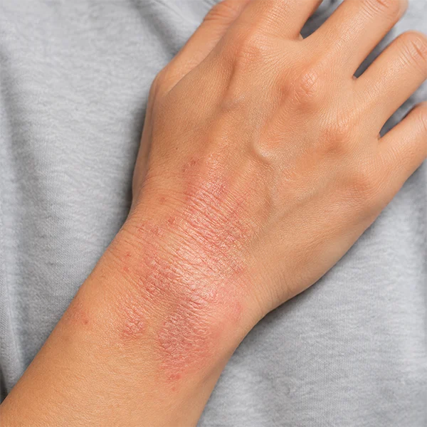 Eczema treatment