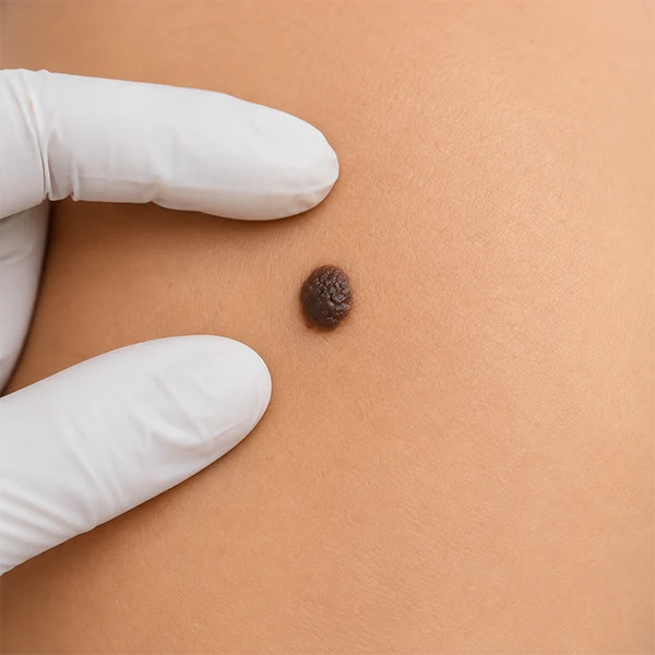 Mole removal treatment