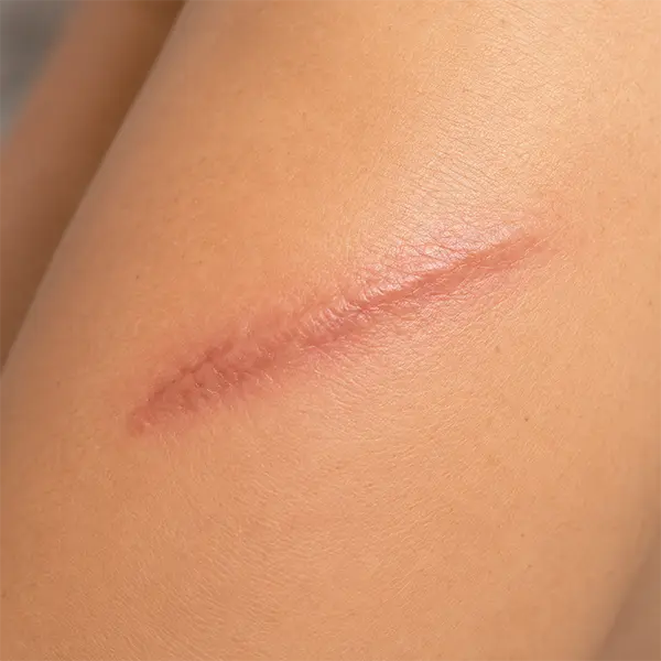 Scar treatment