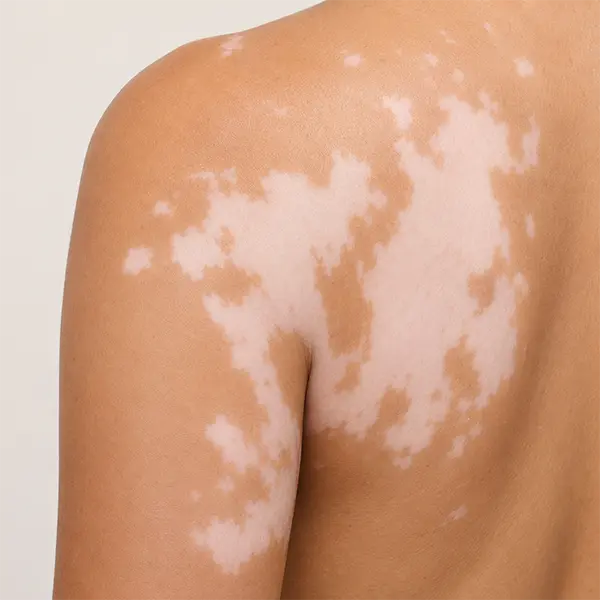 Vitiligo treatment